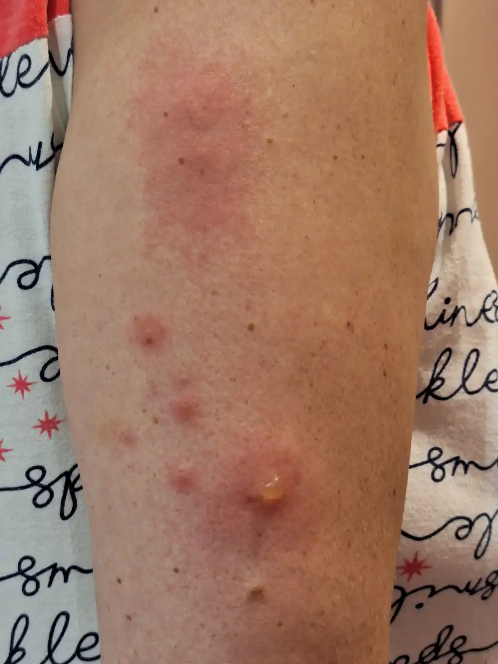 Piqûres groupées compatibles avec des piqûres de punaises de lit