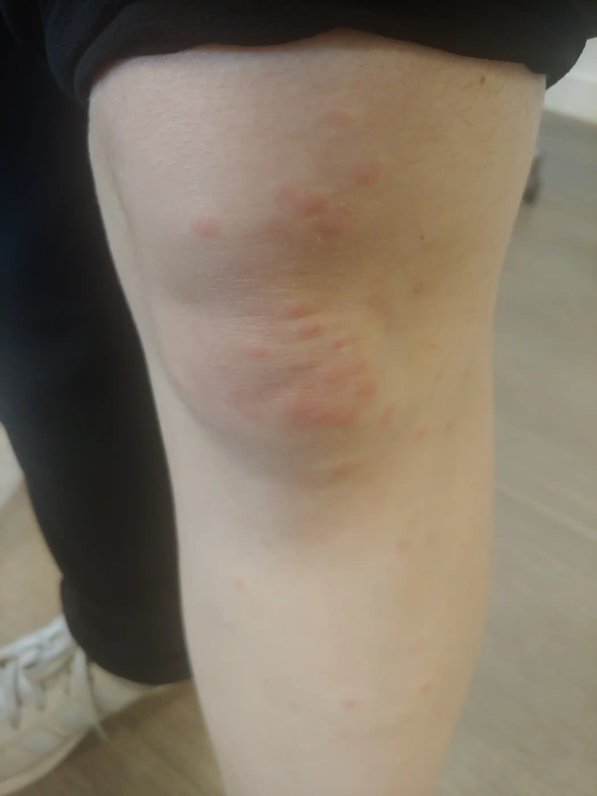 Exemple de marques cutanées à comparer avec d'autres causes possibles