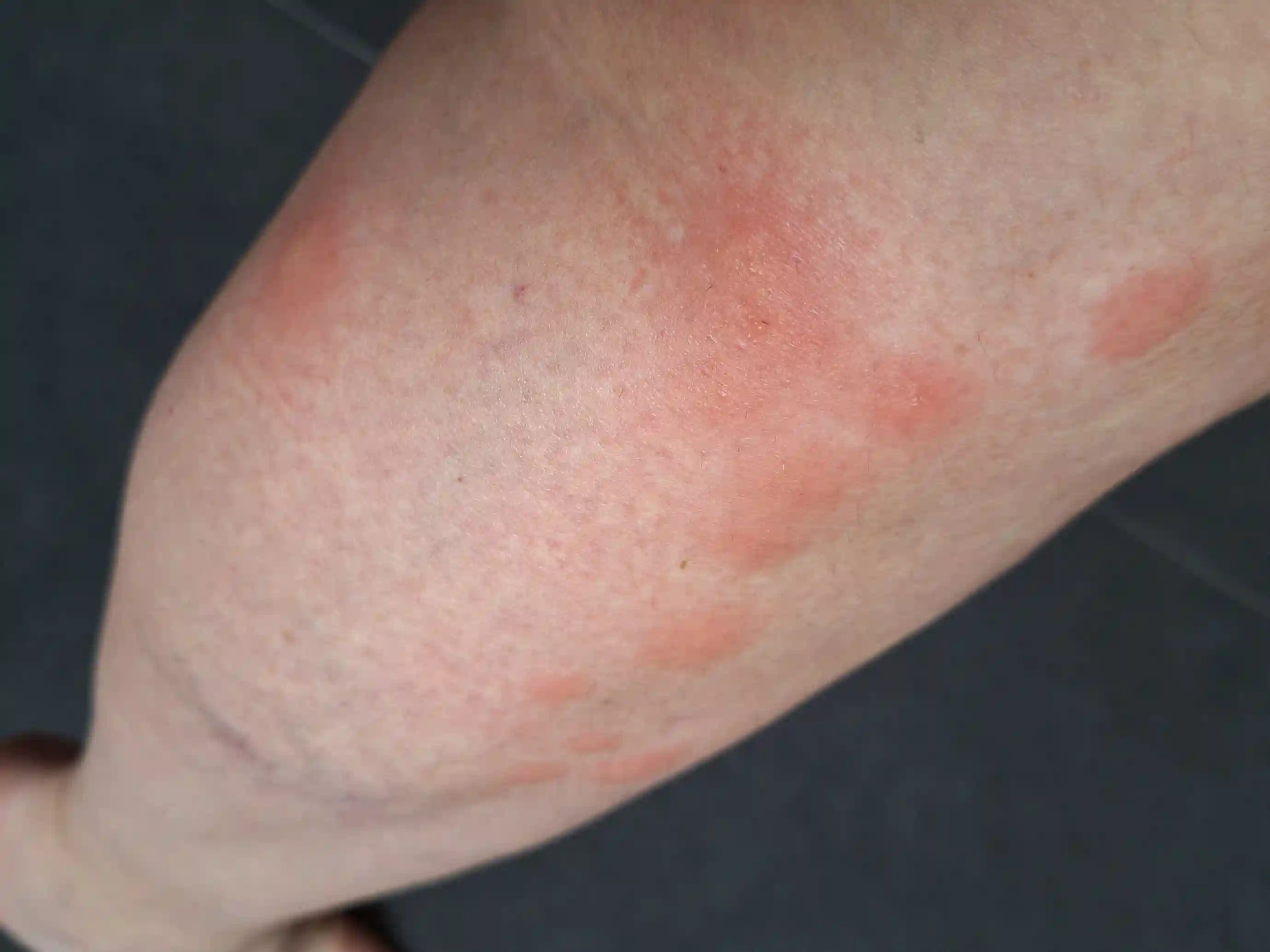 Signes de punaises de lit : La nuit : réactions qui reviennent